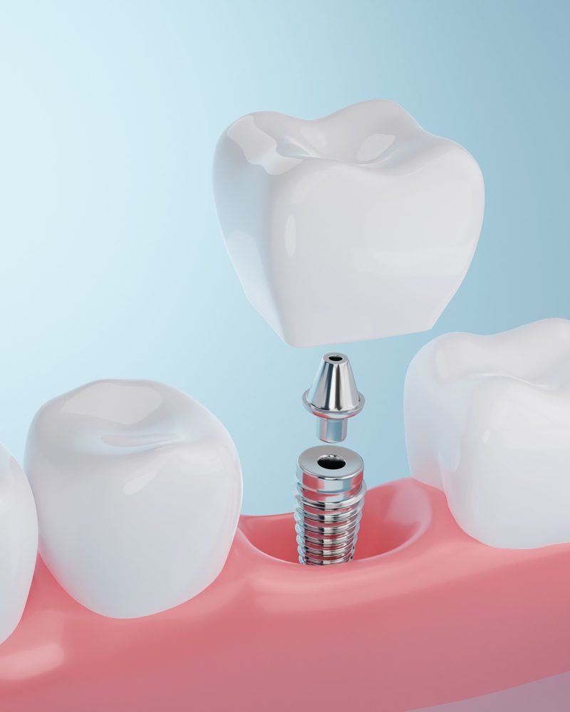 Cosmetic Dentist in Zephyrhills, FL - Dental Implants